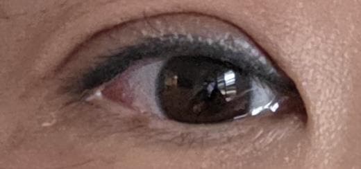 쌍수 2달이 넘었다면 망한거겠죠? 